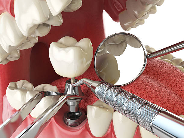 Best Emergency Treatment for Dental Infections or Abscesses in Park Center, CO